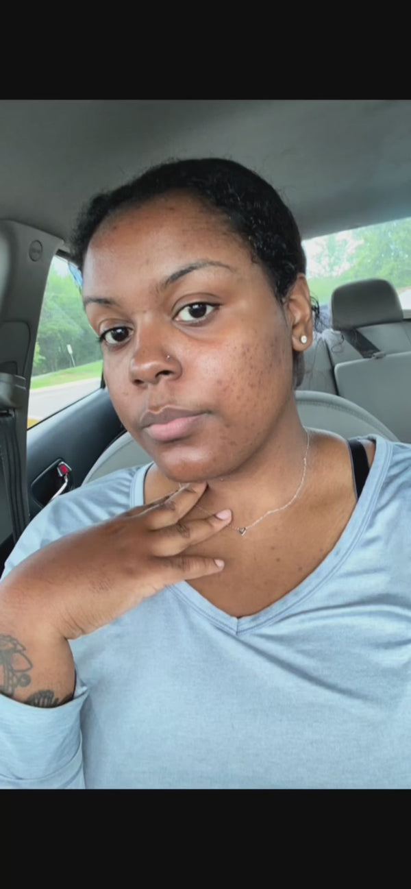 a woman showing how she faded discoloration and uneven skin tone and got clear skin by using Sucre Naturals Koji Glow cleanser and kojic soap